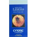 Neoplastic Lesions: Cytotec - Hardcover